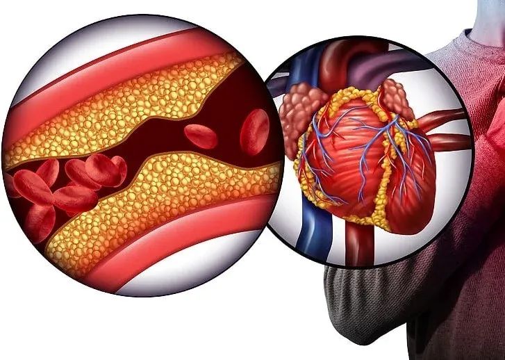 BỆNH TIM MẠCH, ĐỘT QUỴ, NHỒI MÁU CƠ TIM ĐANG PHÁT TRIỂN Ở NHIỀU ĐỘ TUỔI 