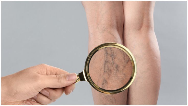 ĐÔI CHÂN NẶNG NỀ, TÊ MỎI KÉO DÀI? CÓ THỂ LÀ SUY GIÃN TĨNH MẠCH