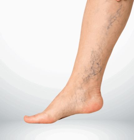 SUY GIÃN TĨNH MẠCH: KHI ĐÔI CHÂN NẶNG NỀ ẢNH HƯỞNG ĐẾN CHẤT LƯỢNG CUỘC SỐNG